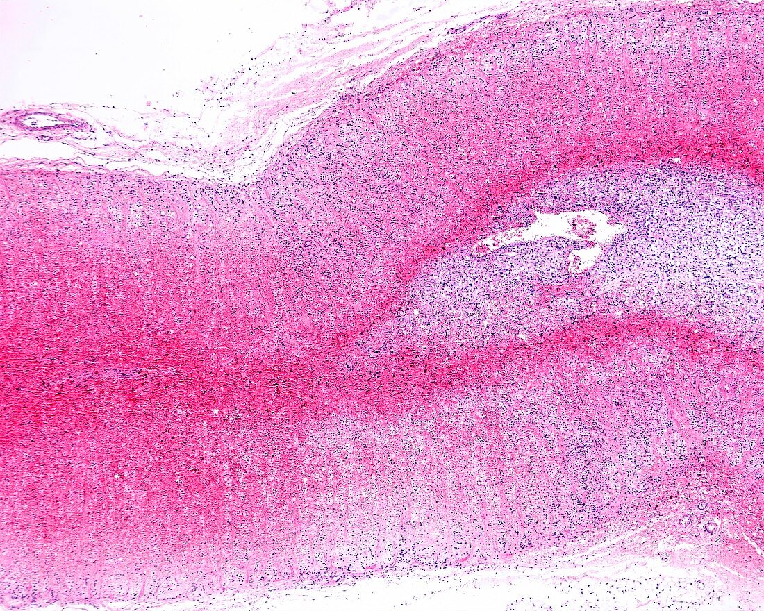 Waterhouse-Friderischen syndrome, light micrograph