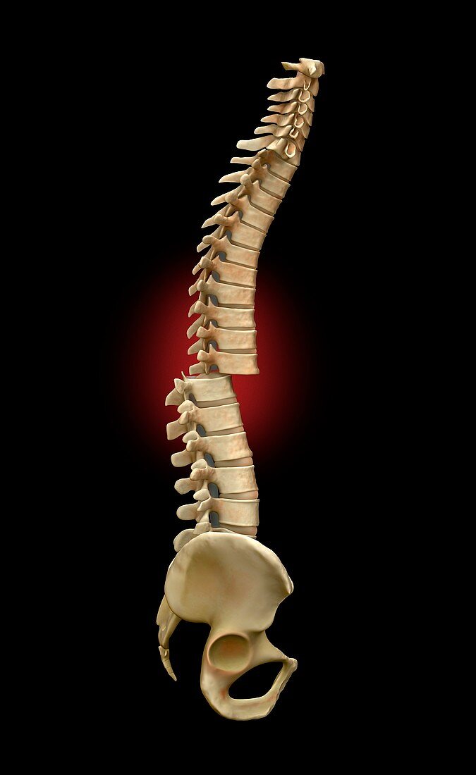 Broken backbone, illustration