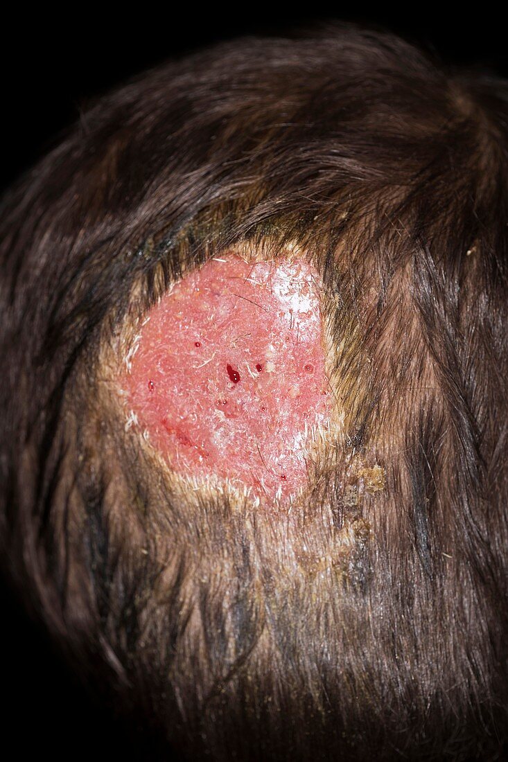 Kerion fungal scalp infection
