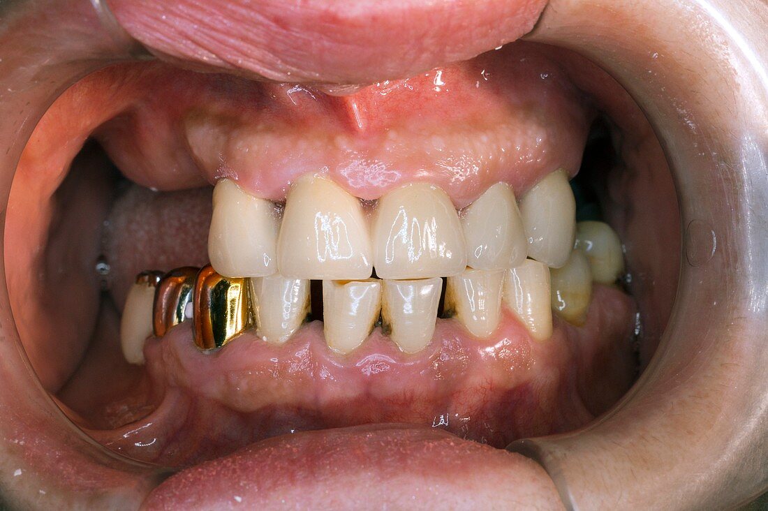 Dental bridge implanted