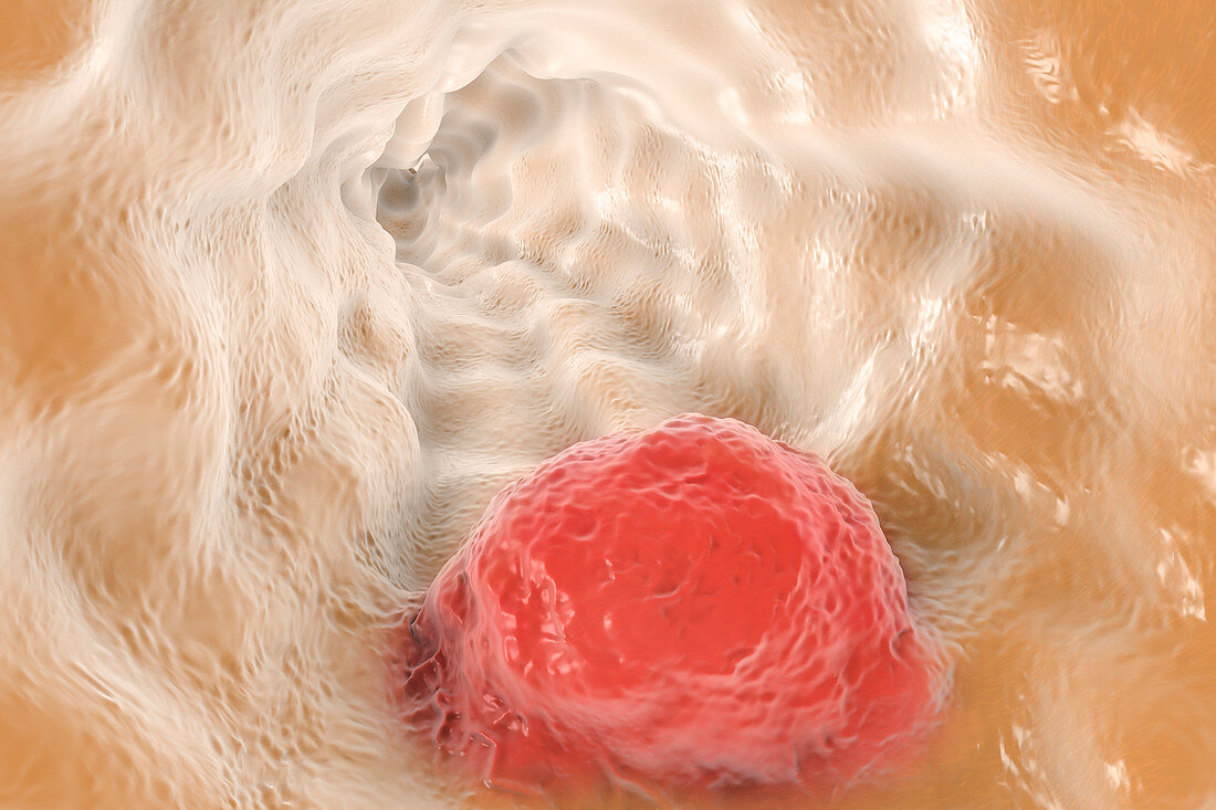 Oesophageal cancer, illustration