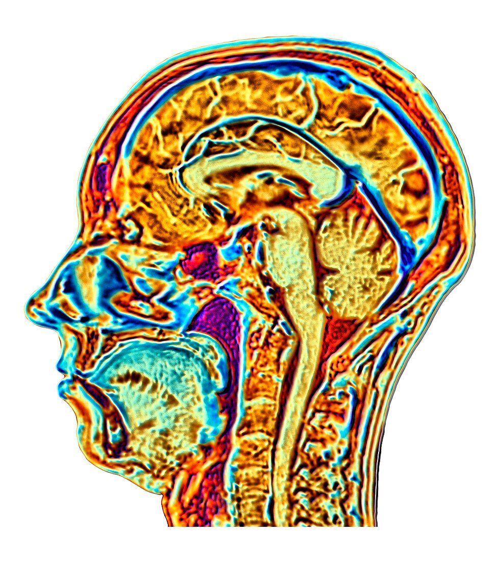 MRI scan of normal brain, artwork