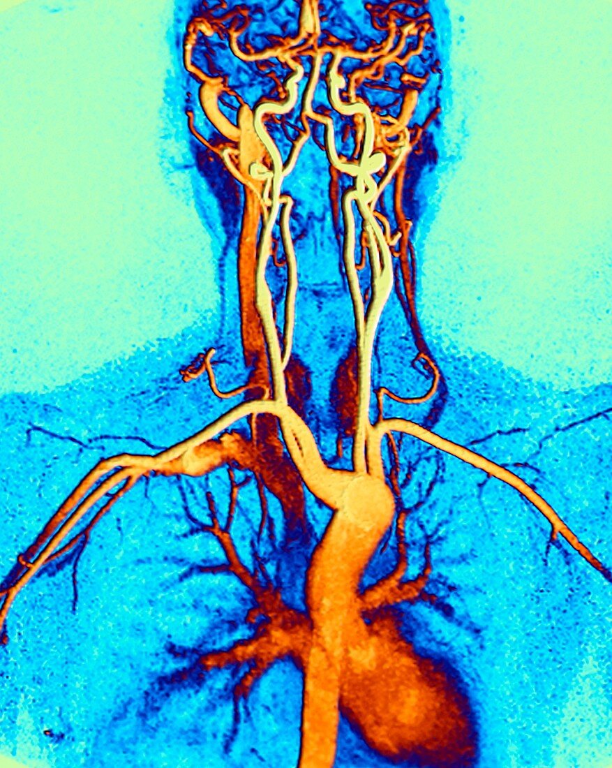 Chest, neck and head arteries, MRA scan