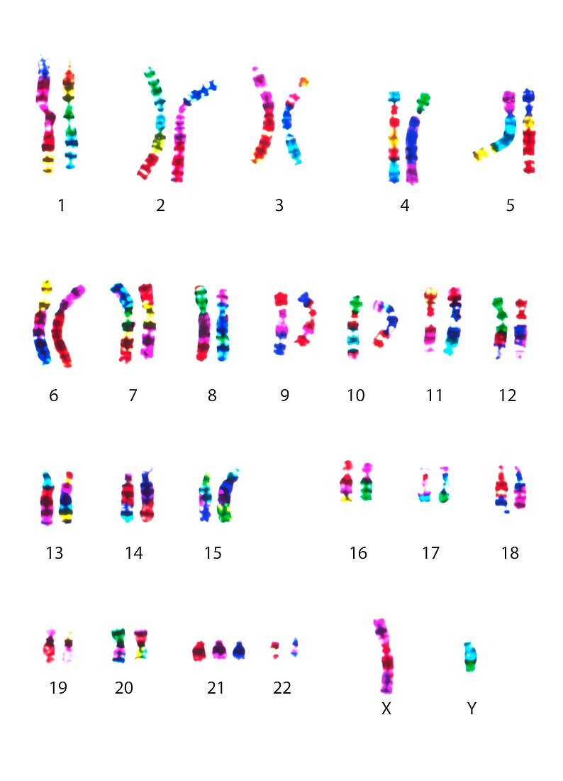 Chromosomes in Down's syndrome