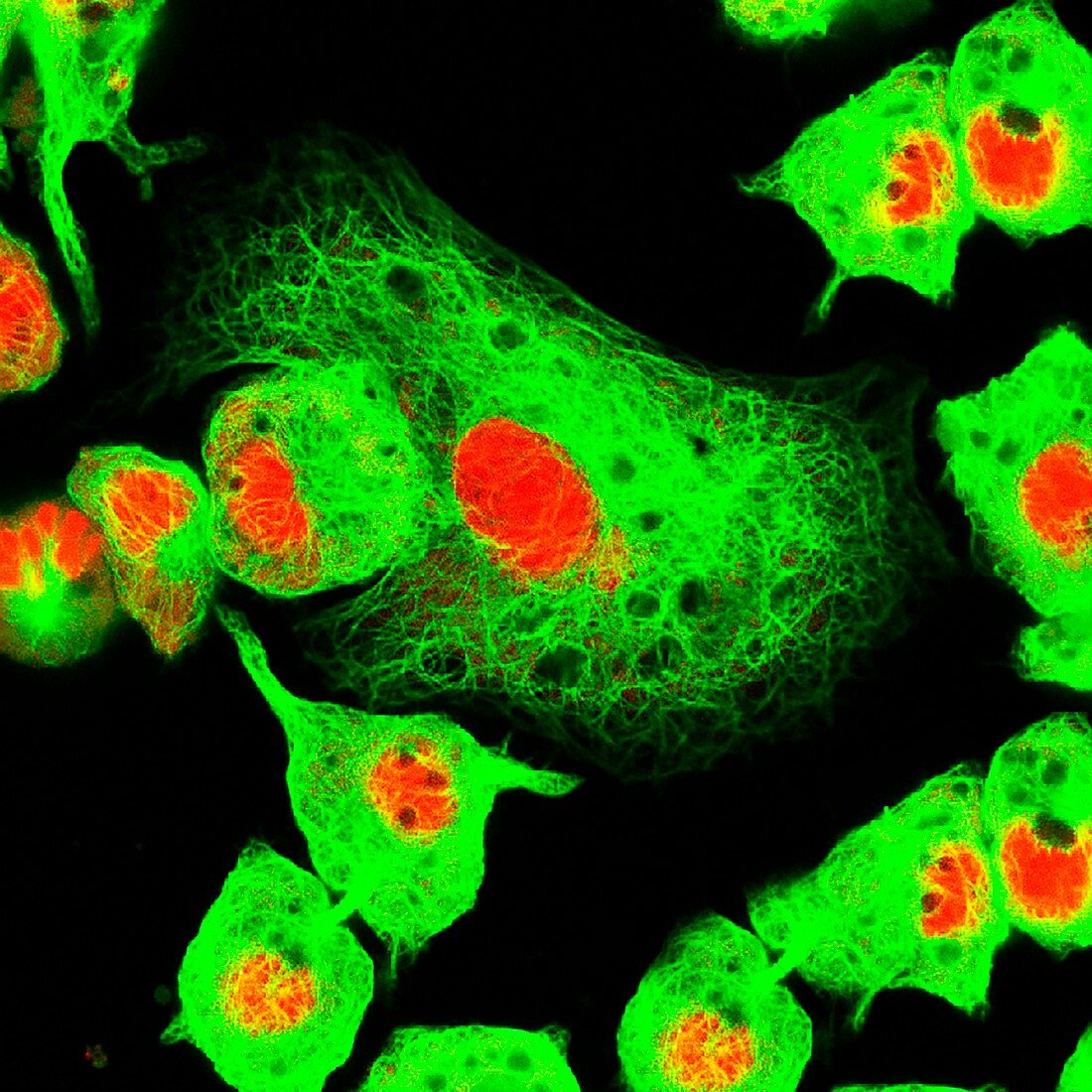Neuroblastoma cells, fluorescence light micrograph