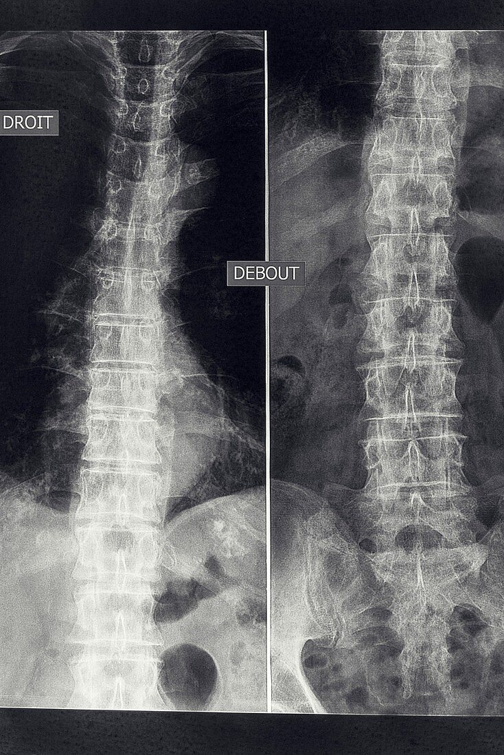 Osteoarthritis of the lumber spine, X-ray