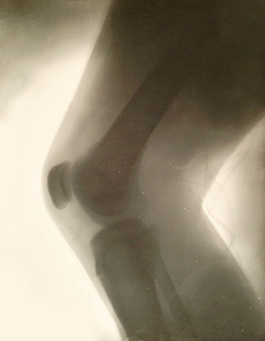 Knee X-ray, 1896