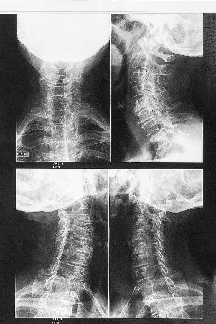 Osteoarthritis of the neck, X-ray