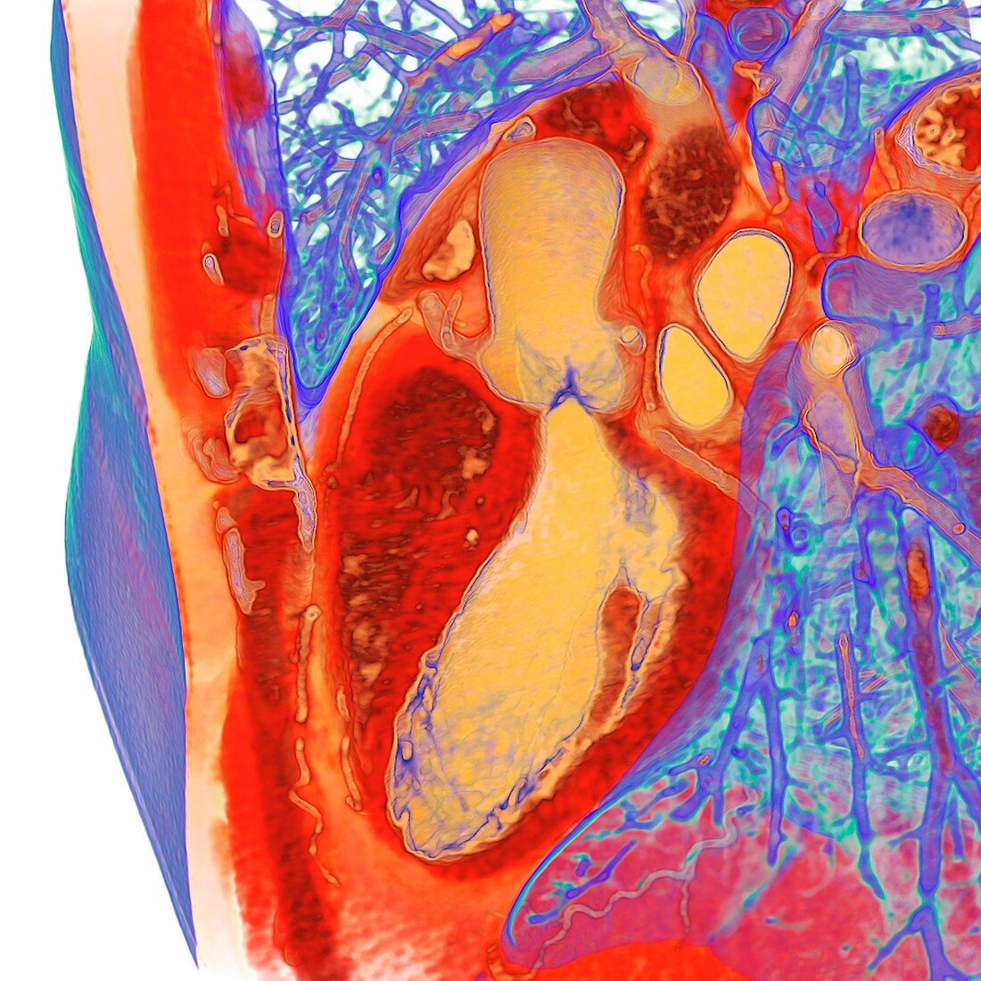 Heart and left ventricle, 3D CT scan