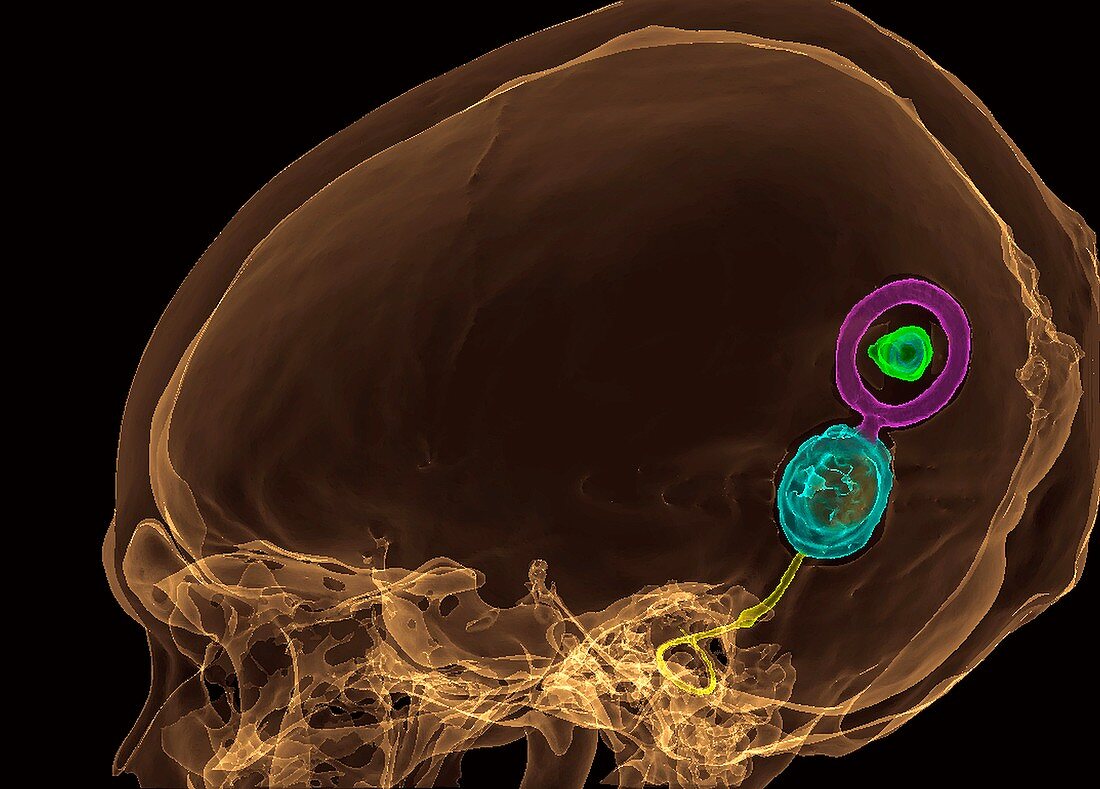 Cochlear implant, 3D CT scan