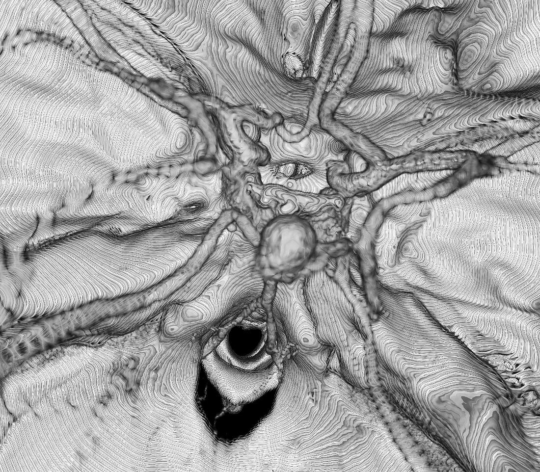 Cerebral aneurysm, 3D CT scan