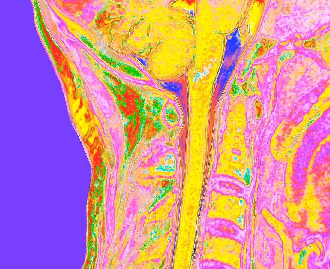 Upper spinal cord and vertebrae, 3D MRI scan