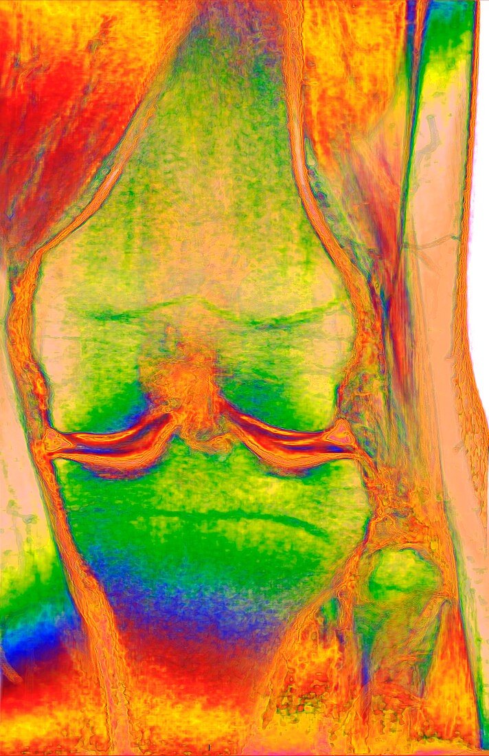 Human knee, 3D MRI scan
