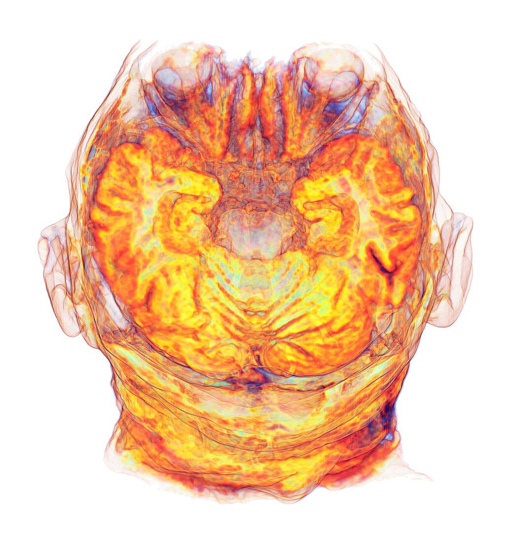 Human head and brain, 3D MRI scan