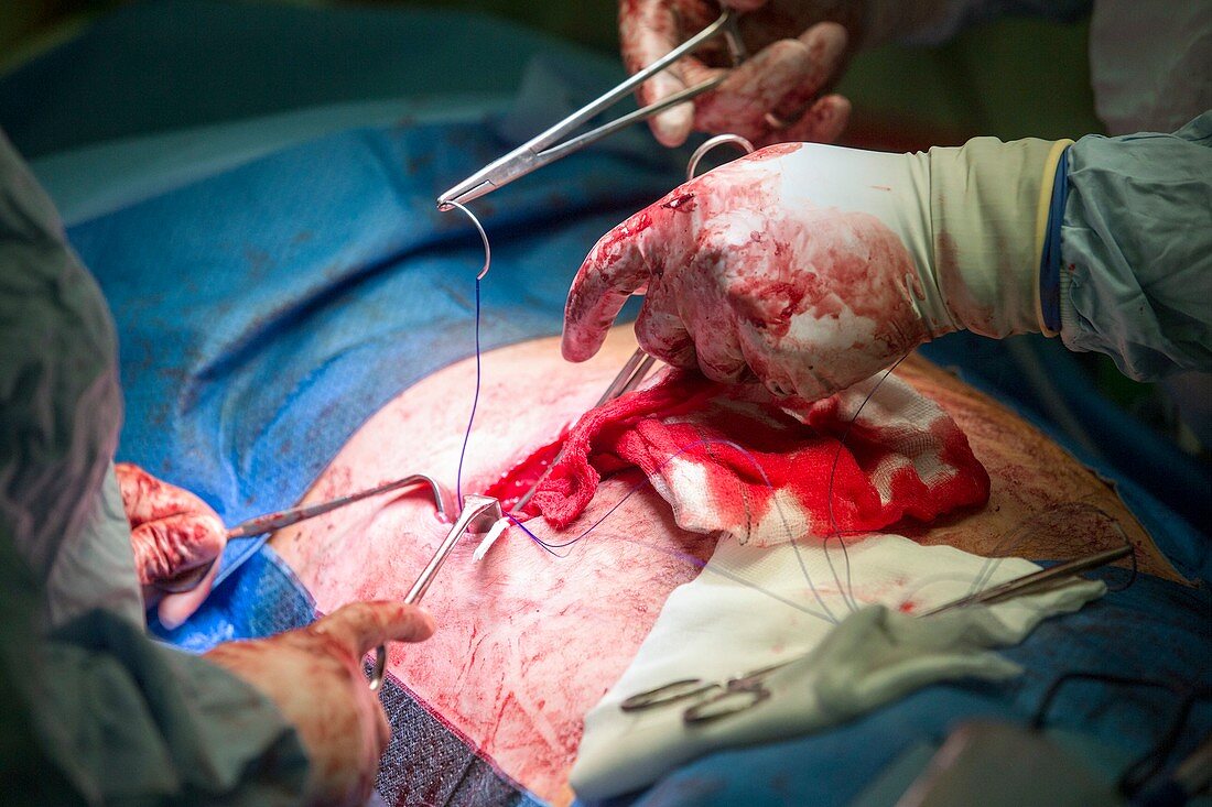 Intestinal surgery, close-up