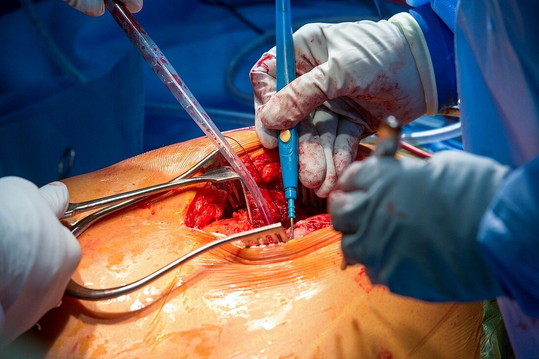Hip replacement surgery, close-up