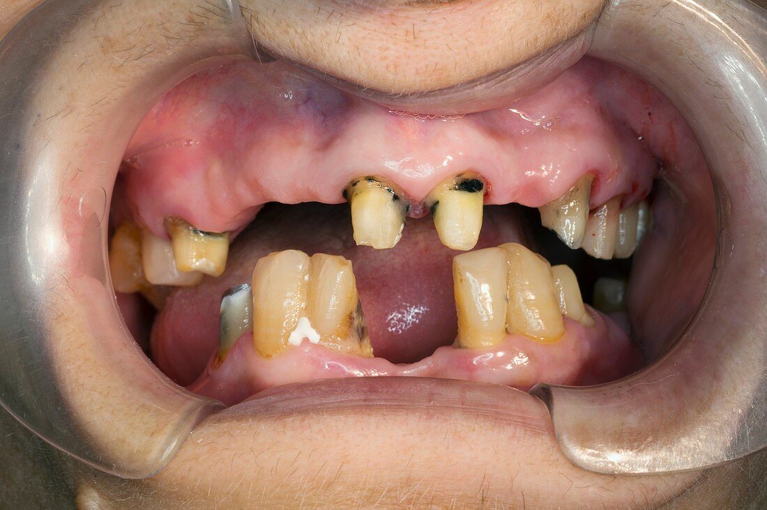 Dental caries and missing teeth