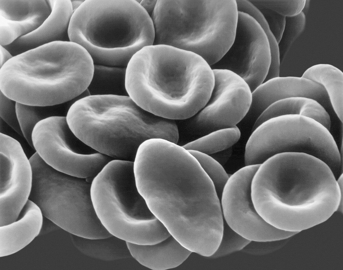 Sickle cell human blood, SEM