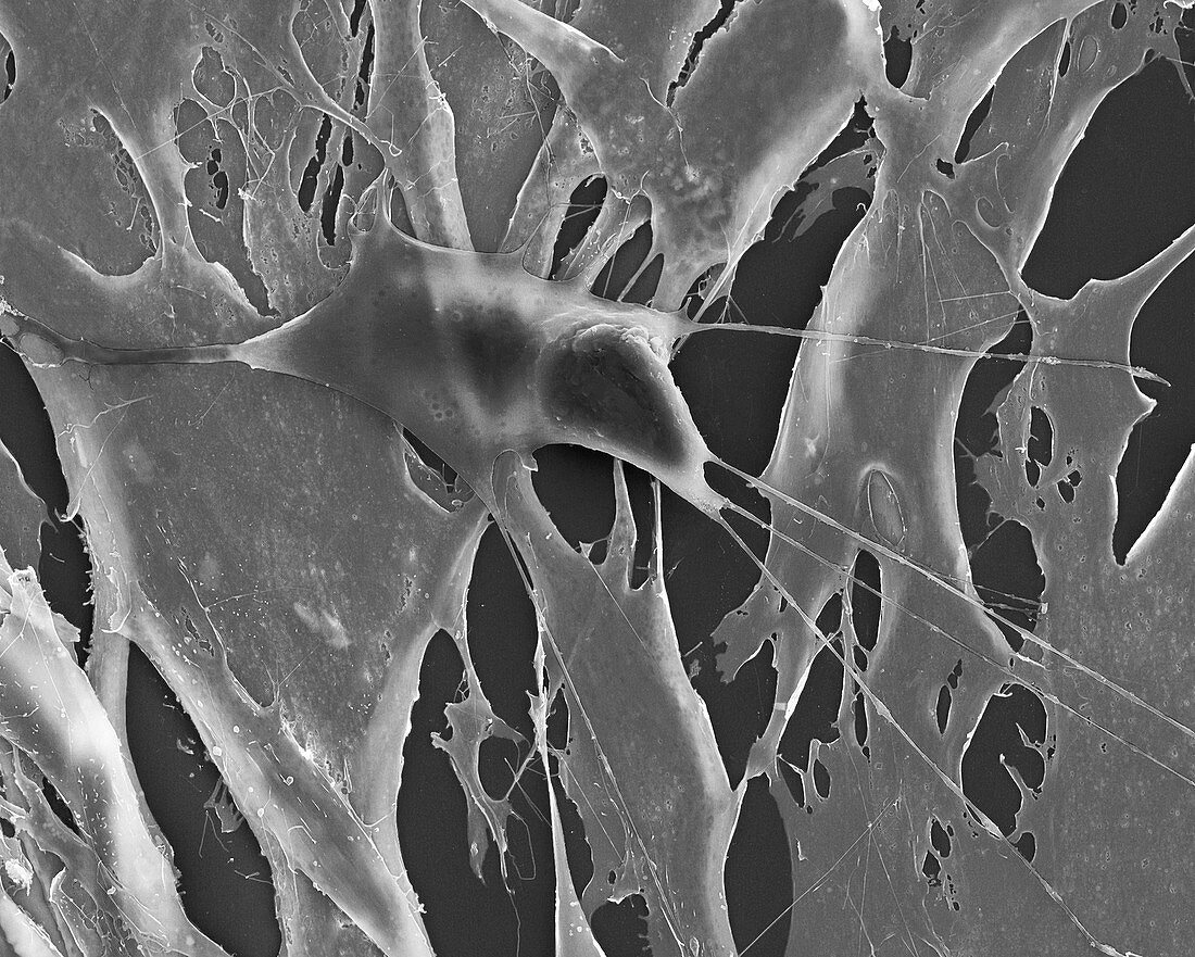 Lung fibroblast cancer cell among healthy fibroblasts, SEM