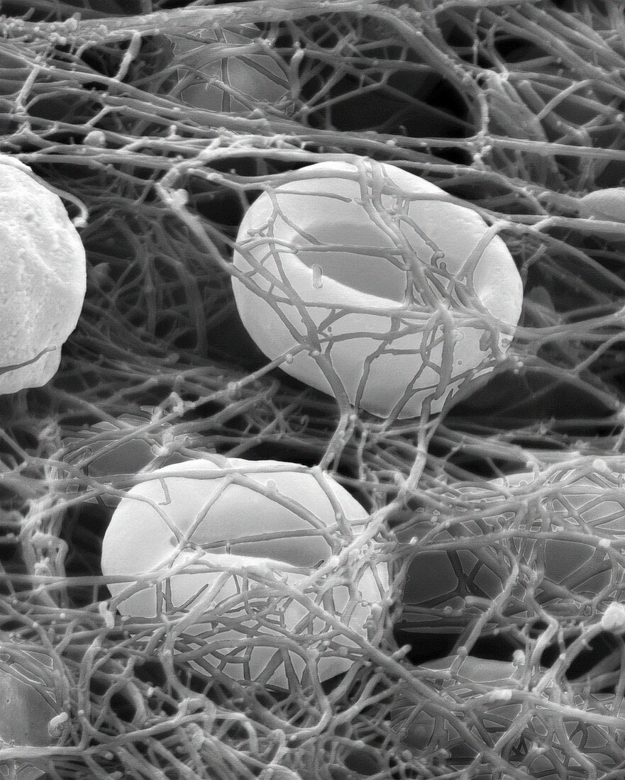 Red blood cells in a blood clot, SEM