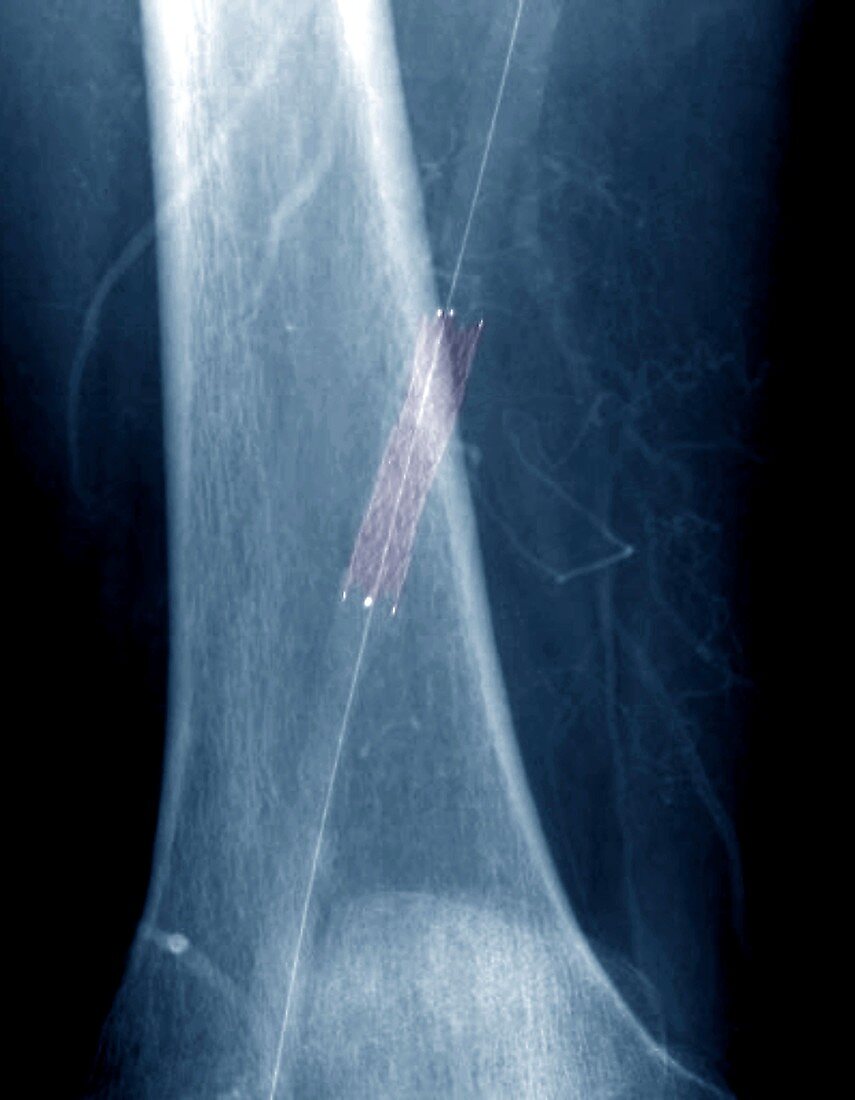 Leg artery angioplasty, X-ray