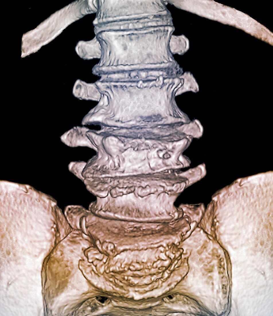 Osteoporotic lumbar spine fracture, 3D CT scan