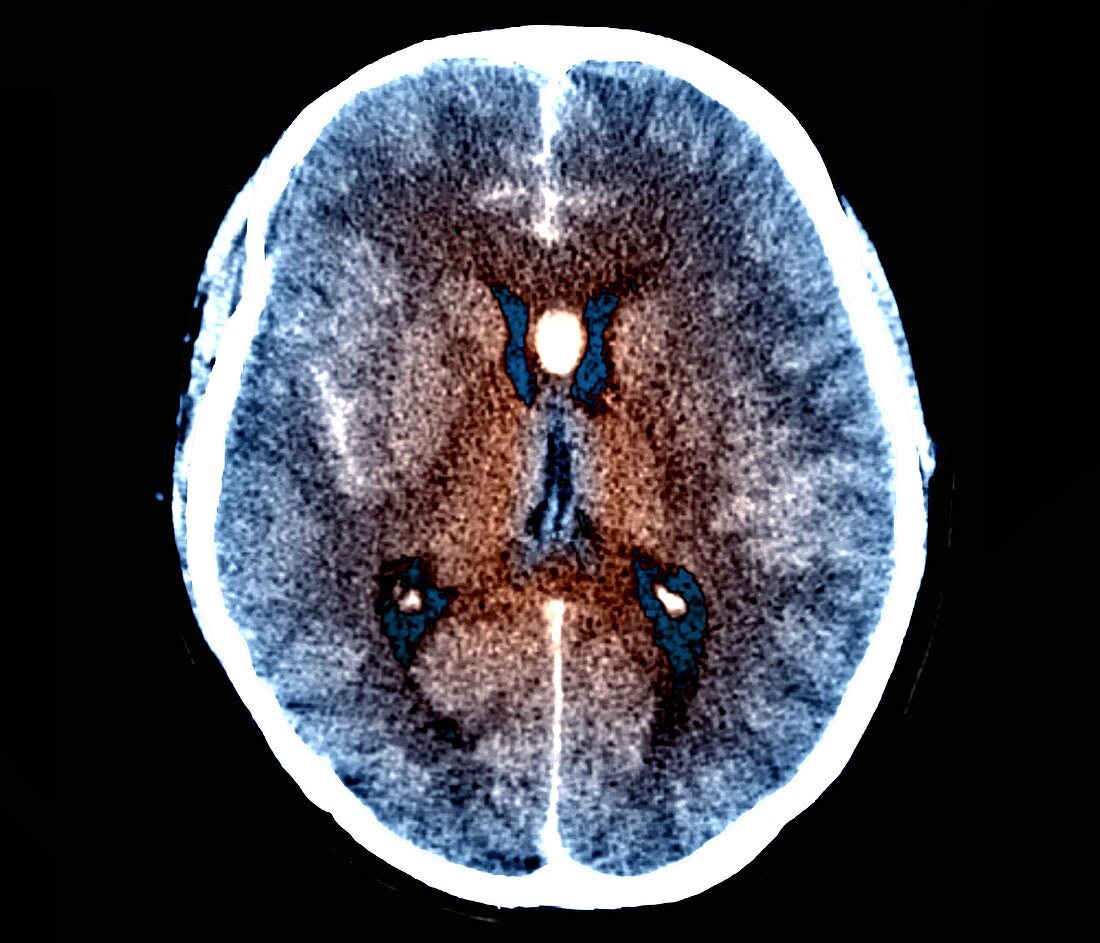 Brain haemorrhage, axial CT scan