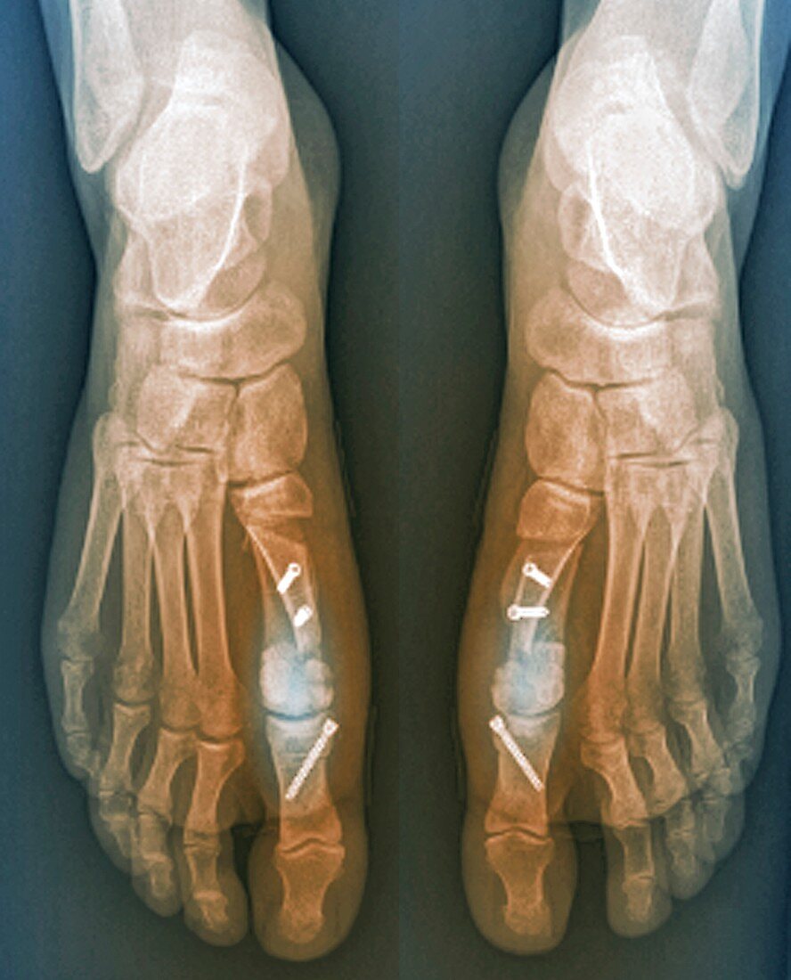 Bunion surgery, feet X-ray