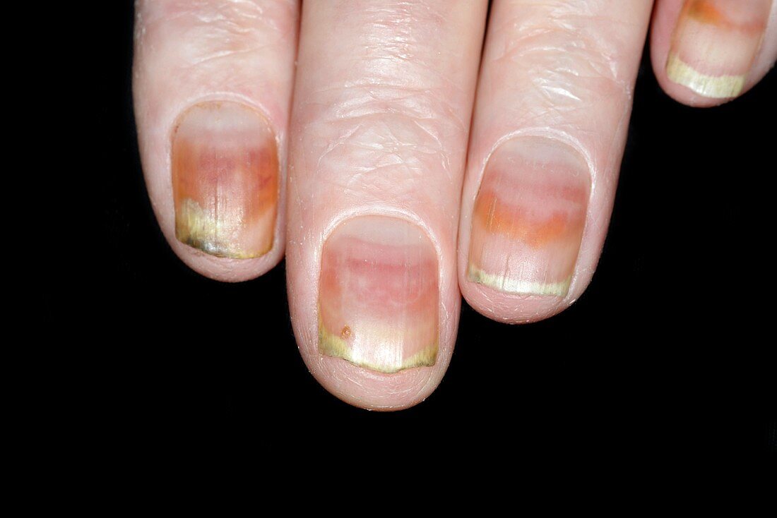 Dystrophic fingernails due to chemotherapy