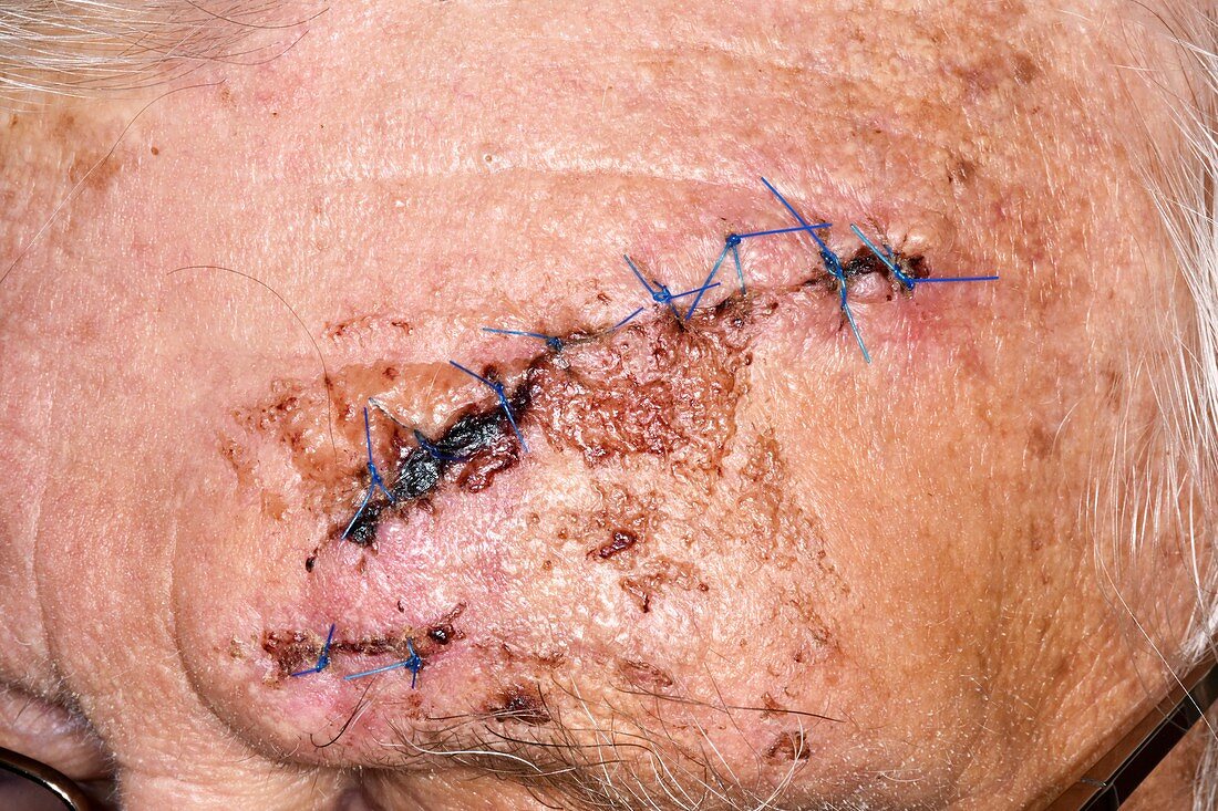 Sutured head wound from a fall
