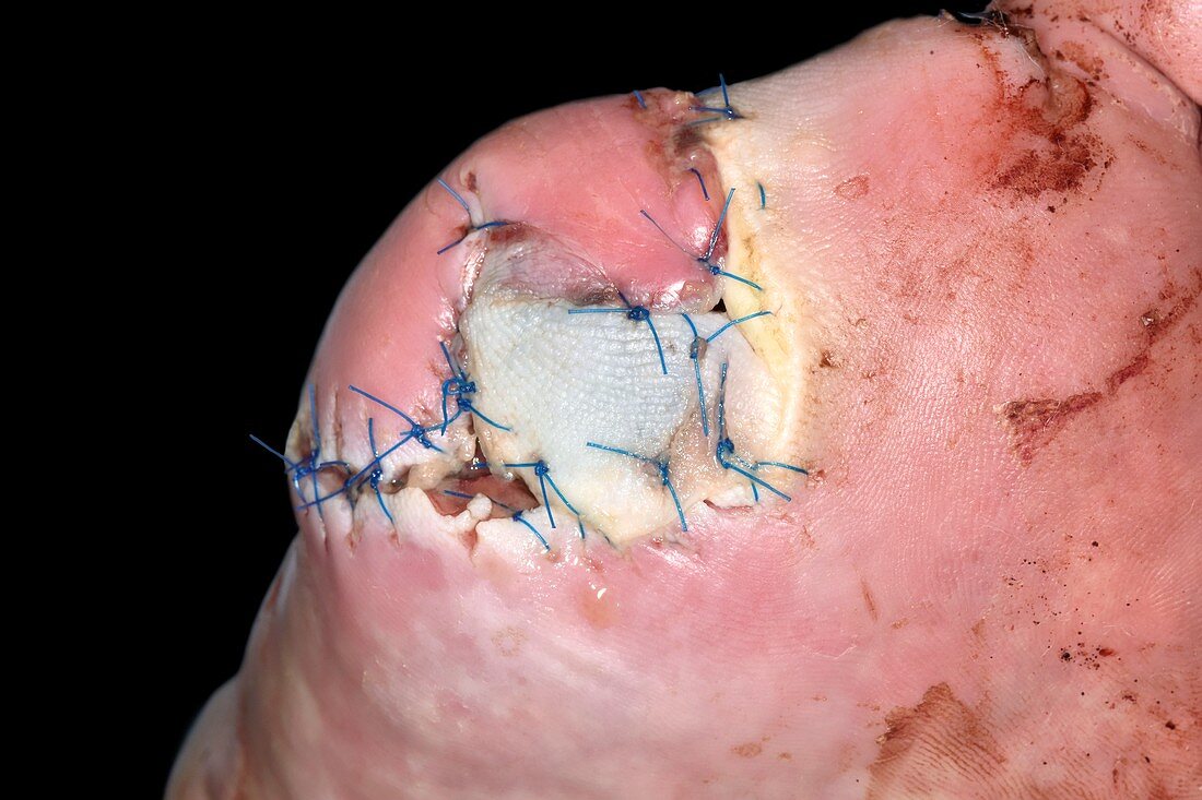 Toe amputation with infection