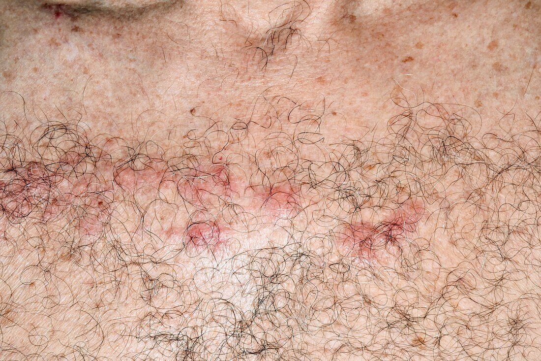 Shingles lesions across the chest midline