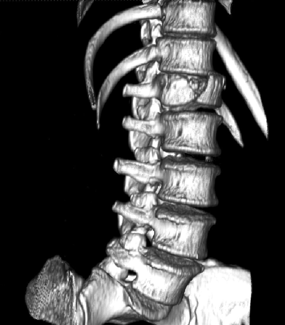 Spinal injury, 3D CT scan