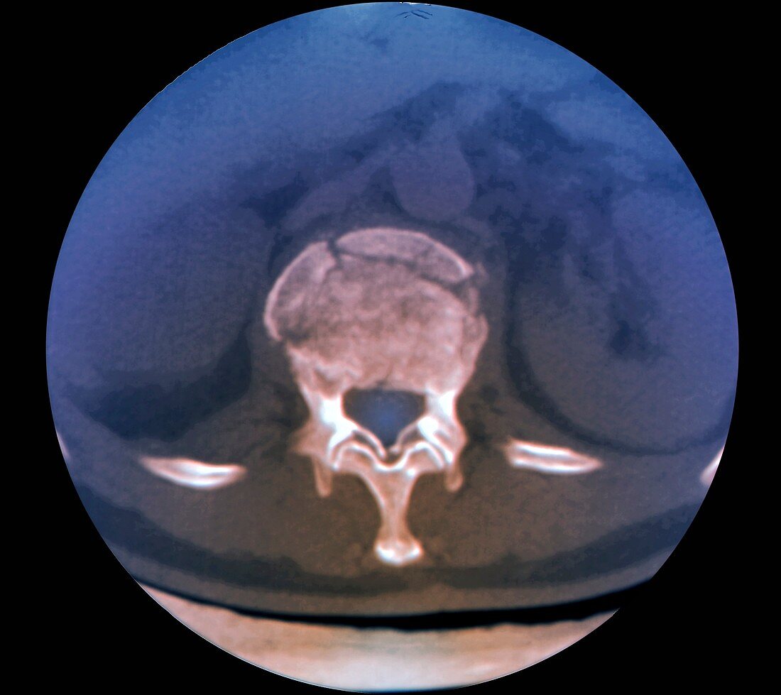 Fractured spine vertebra, CT scan