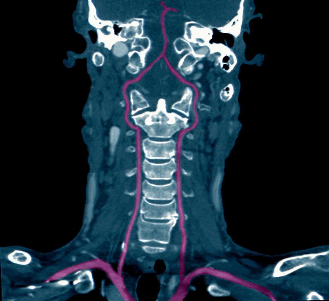Neck arteries and spine, CT angiogram