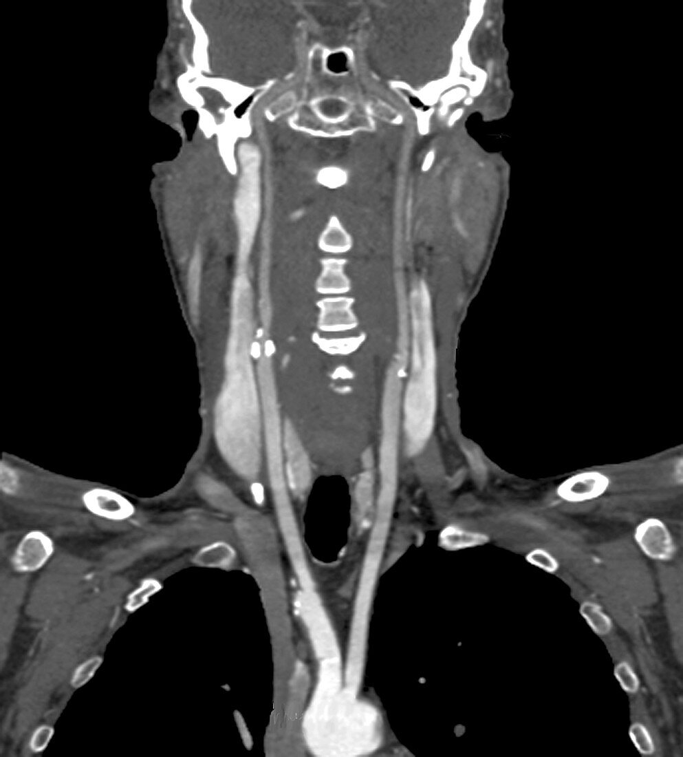 Narrowed carotid arteries, CT angiogram