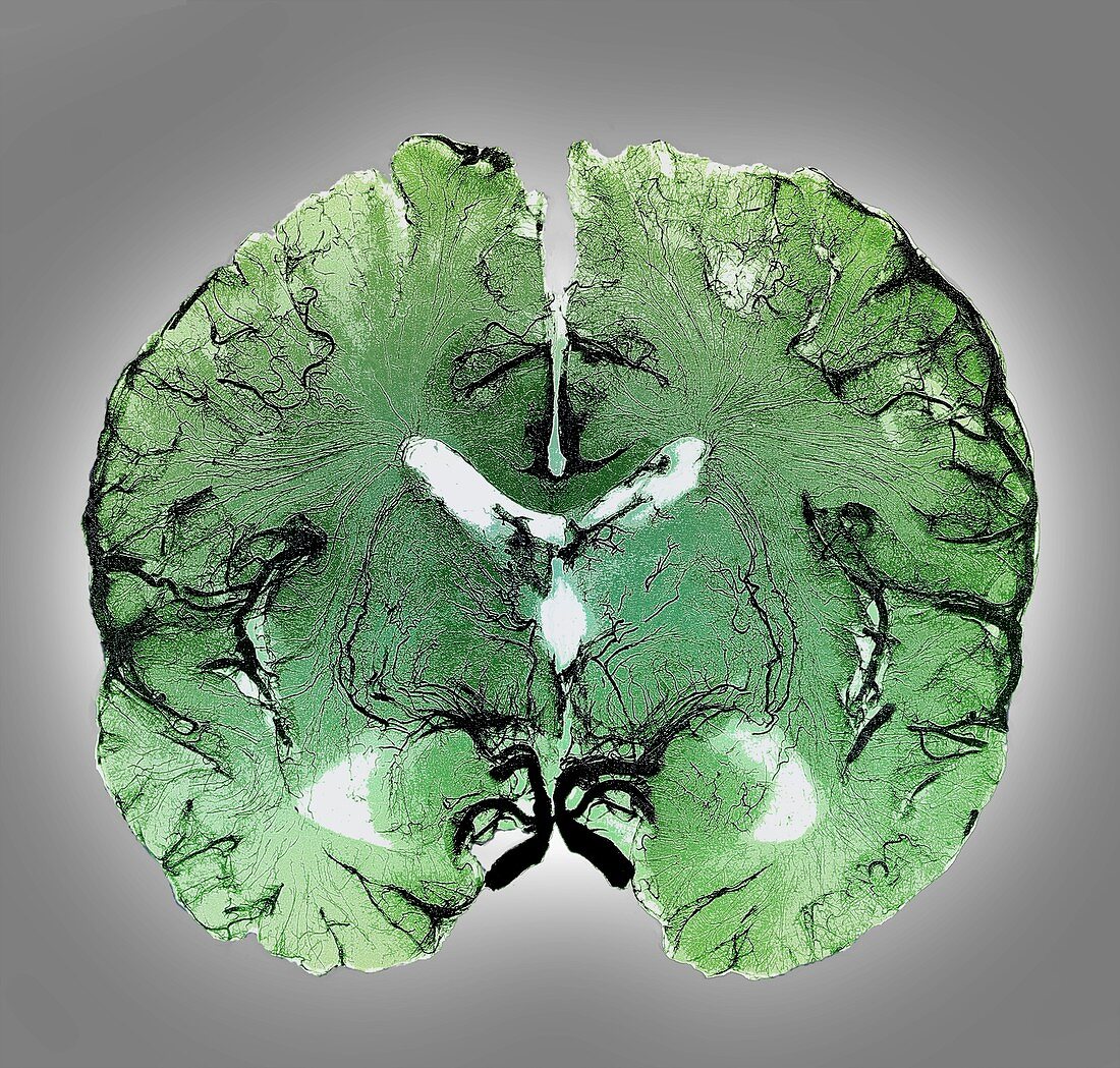 Coronal brain slice specimen