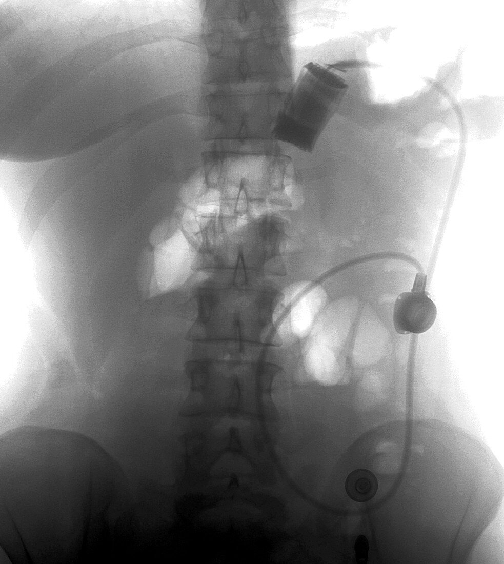 Gastric band, X-ray