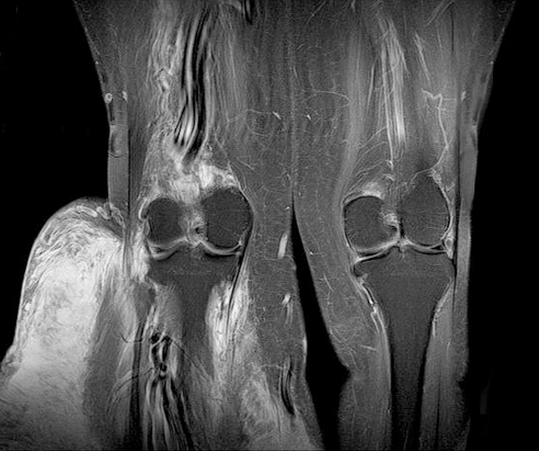 Elephantiasis of the legs, MRI scan