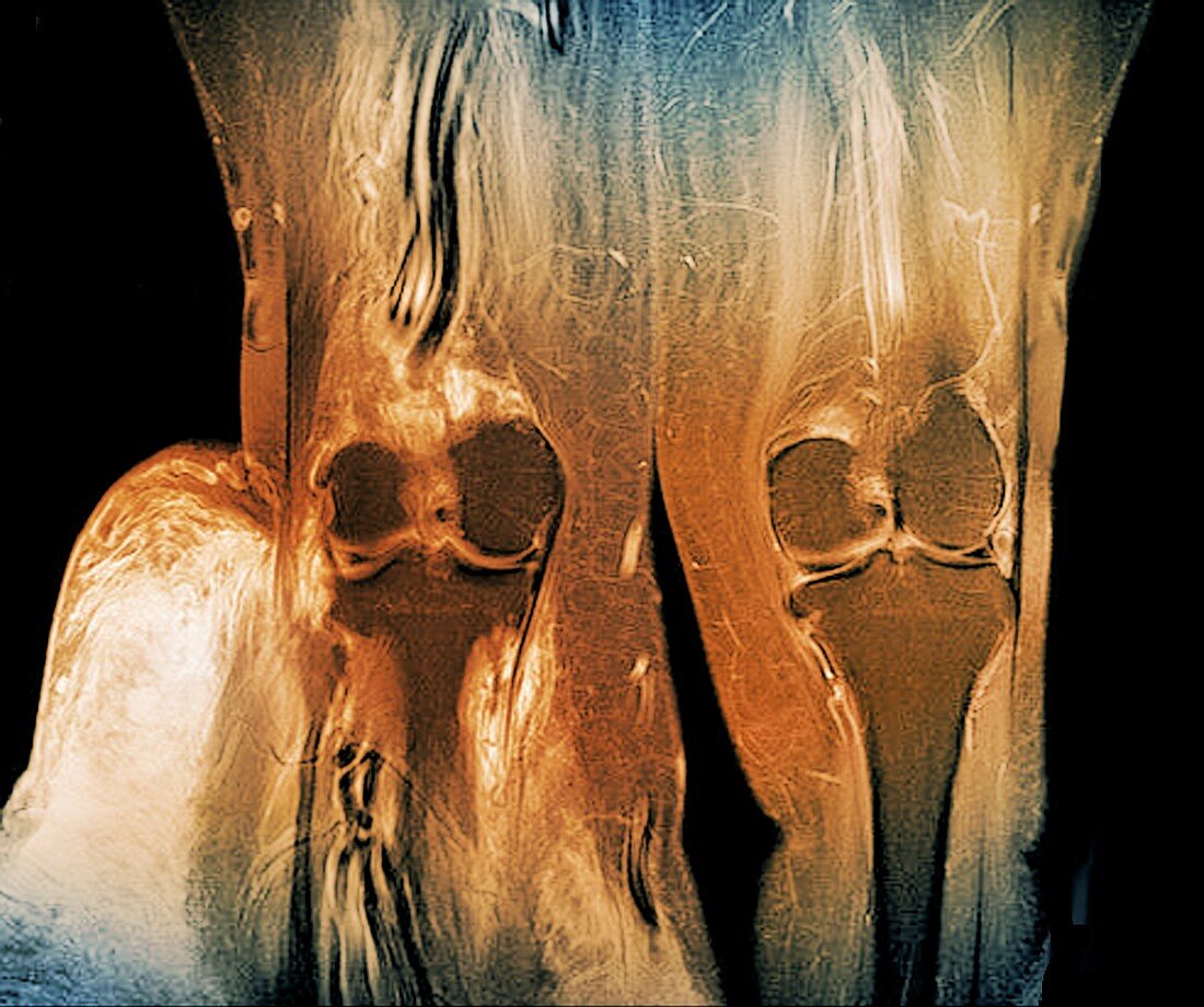 Elephantiasis of the legs, MRI scan