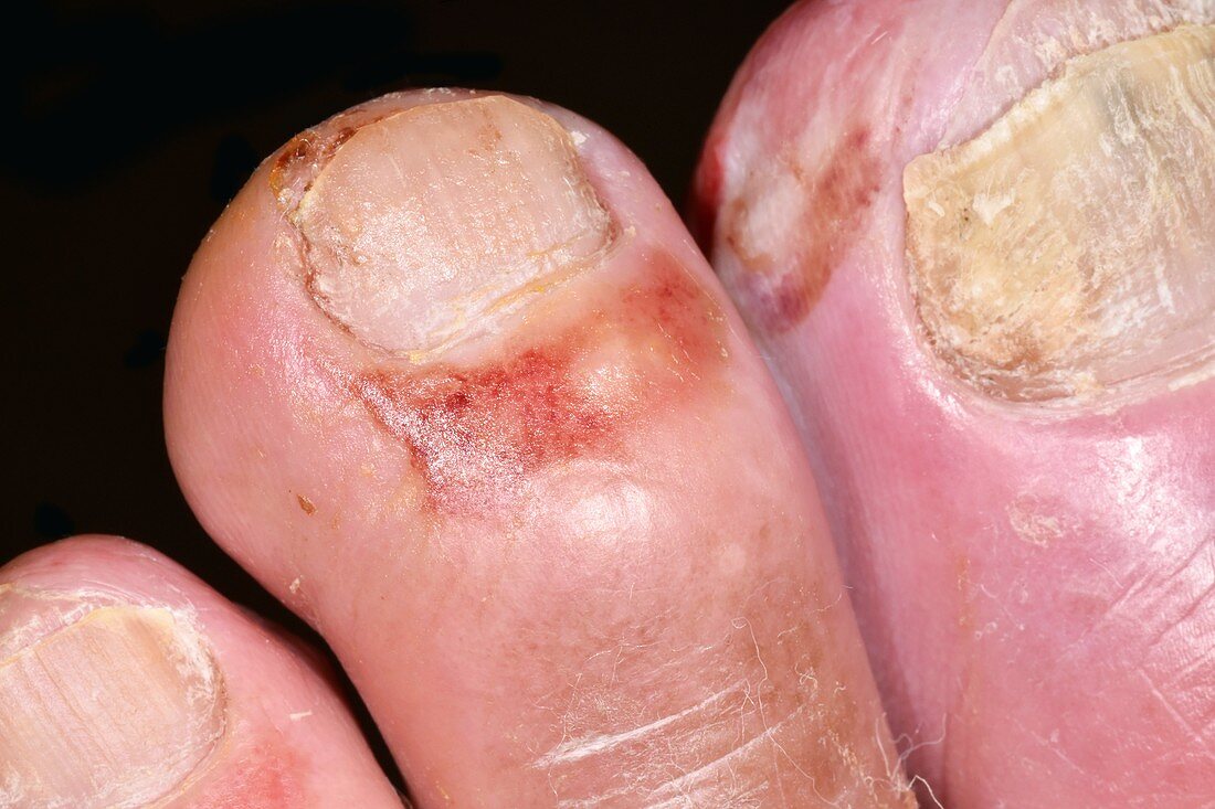 Infected toes in type 1 diabetes