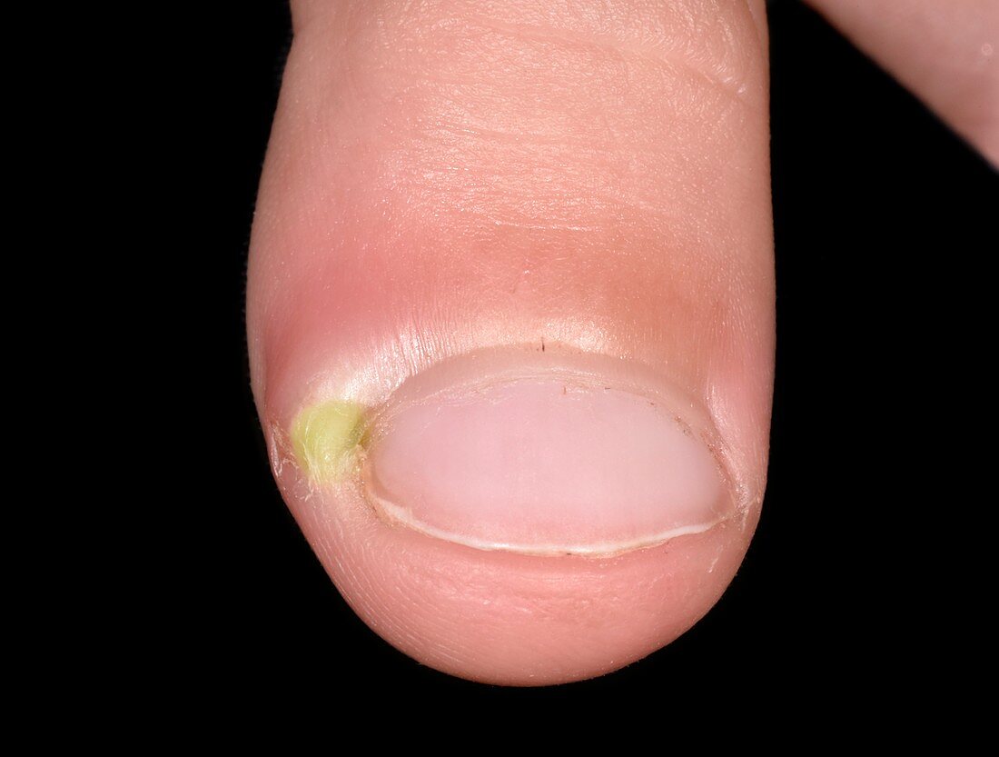 Paronychia infection of the thumb