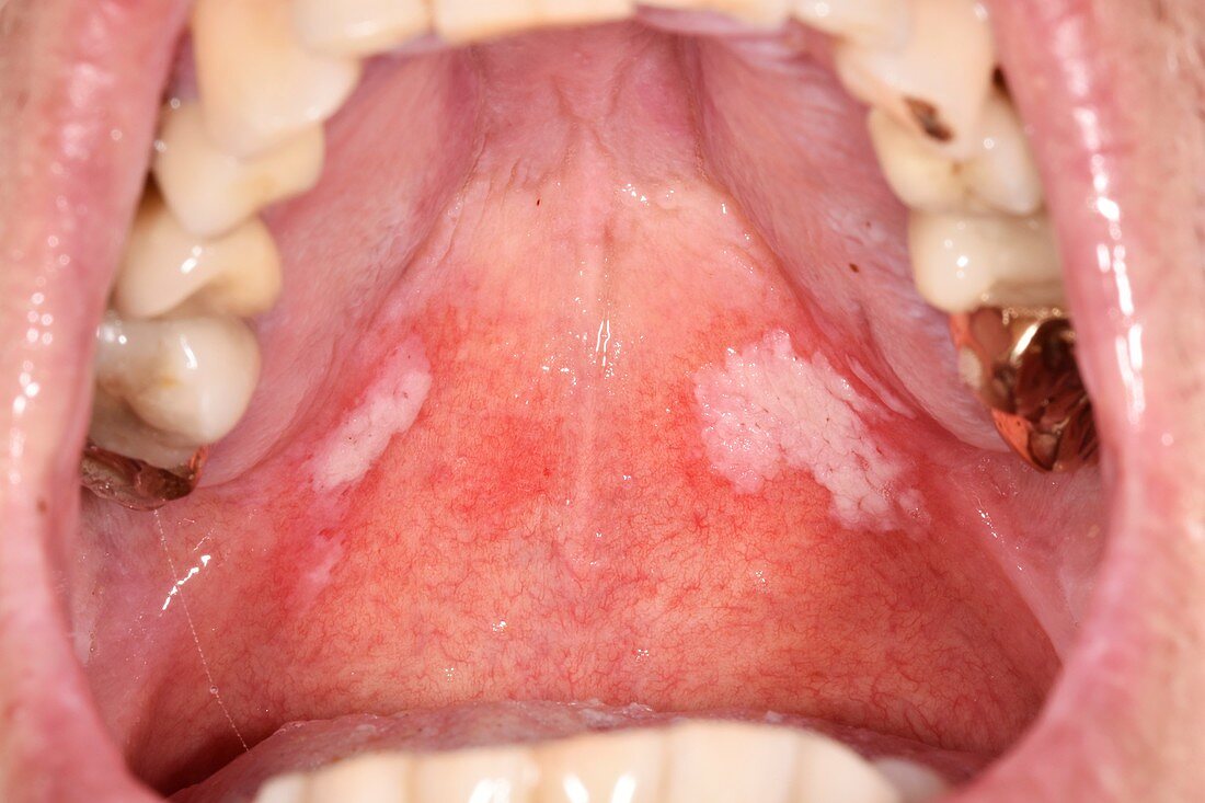 Oral candidiasis or thrush