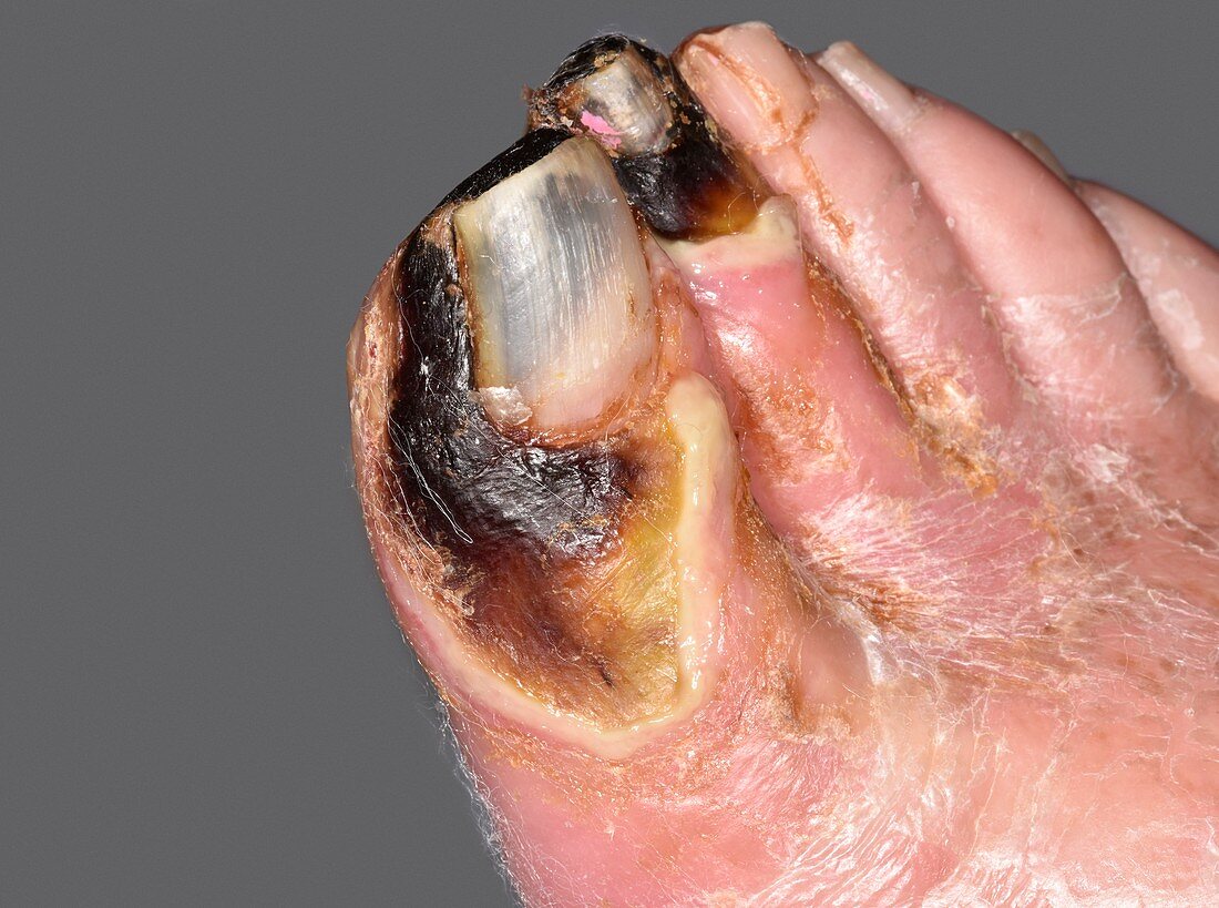 Gangrenous toes caused by diabetes