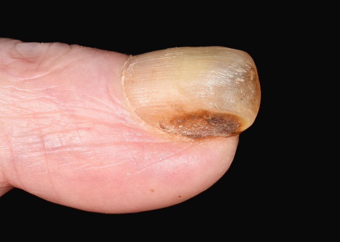Fingernail in pachyonychia congenita