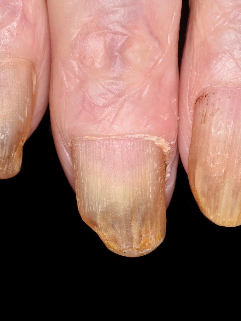 Fingernails in pachyonychia congenita