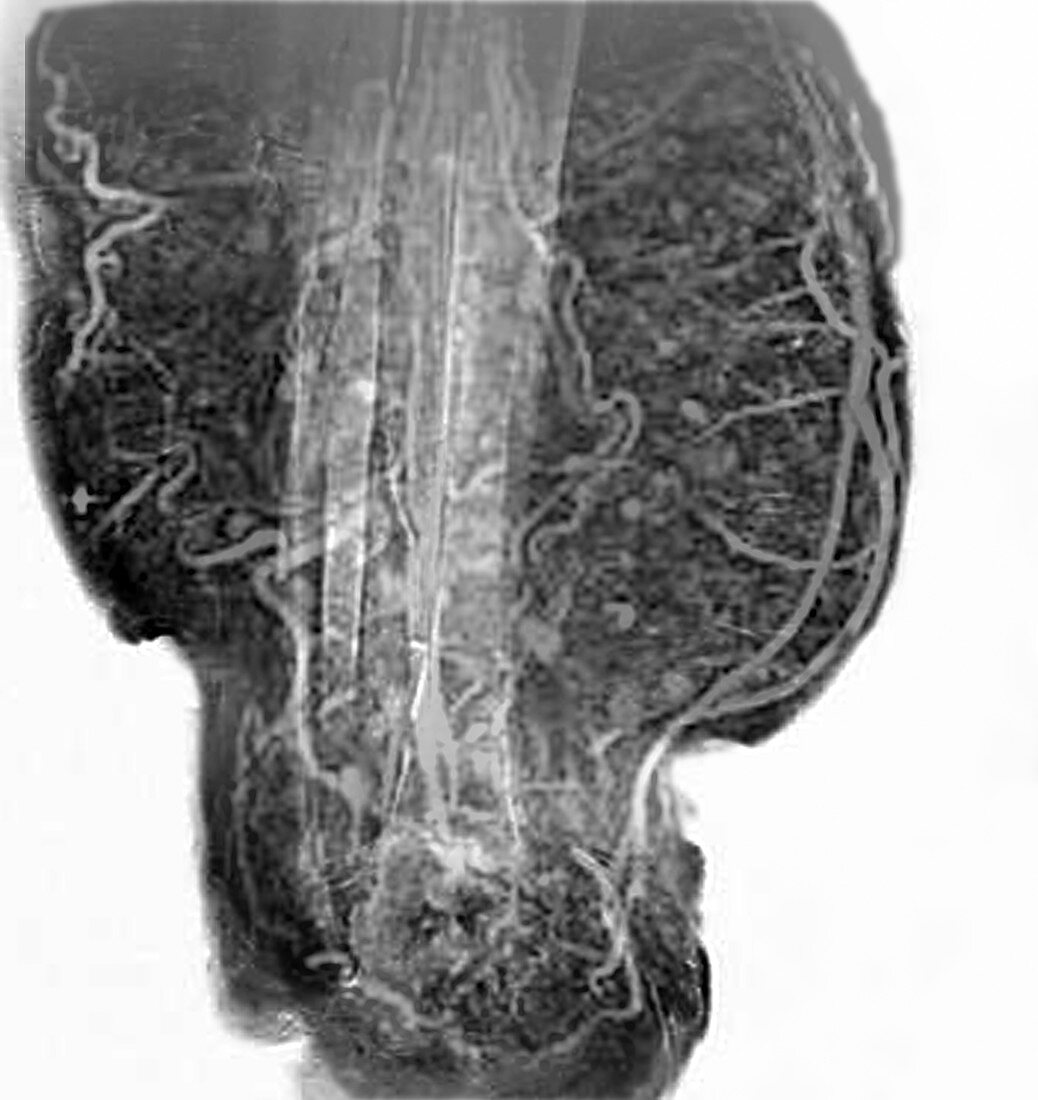 Elephantiasis of the legs, MRA scan
