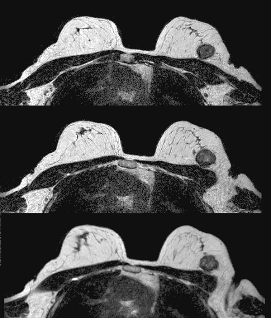 Breast tumour, axial MRI scans