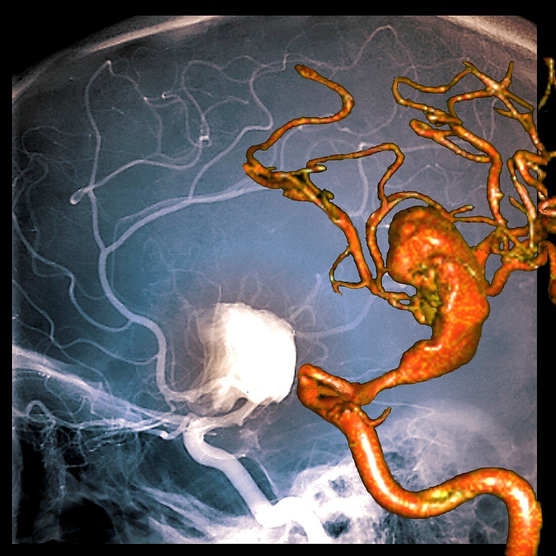 Cerebral aneurysm, 2D and 3D angiograms