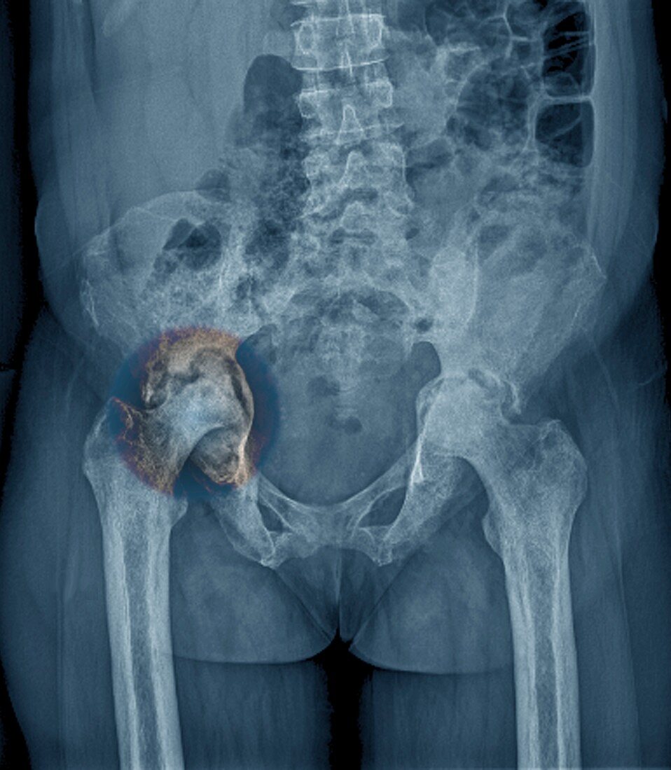 Osteonecrosis of the hip, X-ray